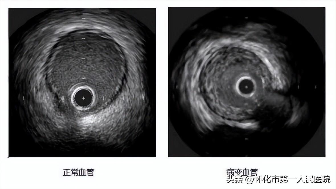 ivus手术全称是什么？ 介入医生的第三只眼